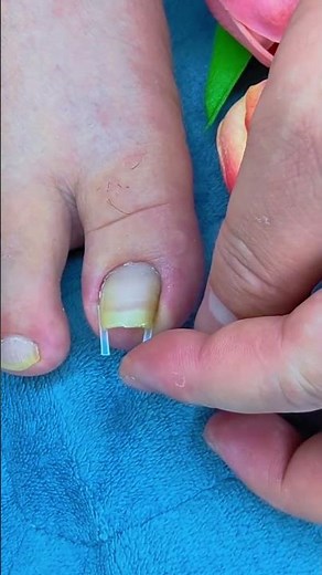 Ingrown Toenail Correction Strips Kit for Pain Relief & Nail Care Tool