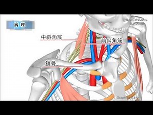 胸郭出口症候群／2分で分かる医療動画辞典 ミルメディカル