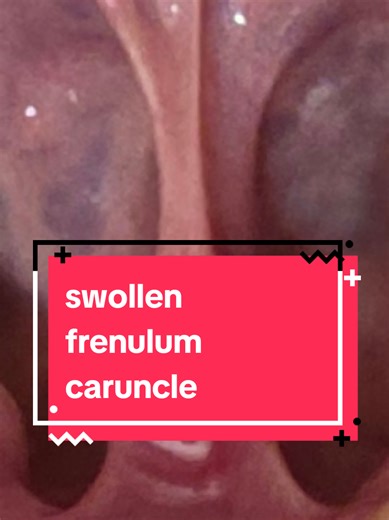 It's so ridiculously painful to talk, chew or exist. what the hell am I reacting to now?! #mcas #inflammation #painrelief #frenulum