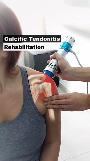 Calcific tendonitis of the shoulder happens when calcium deposits form on the tendons of your shoulder. Shockwave Therapy helps breaking calcium deposits while Active Exercises helps maintaining muscle mass and strength. #tendonitis #shoulderrehabilitation #shockwavetherapy #shoulderexercises