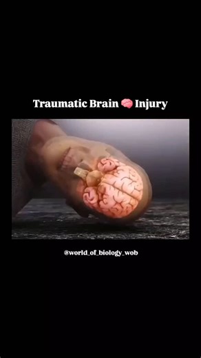 World of Biology on Instagram: "Traumatic brain injury (TBI) profoundly damages neurons through a complex cascade of mechanical and biochemical events. The initial physical impact causes immediate damage, followed by delayed secondary injury mechanisms that cause widespread neuronal dysfunction and death, often leading to long-term neurological deficits. 📹 Video credit 📸 - syntropy #braindevelopment #neurology #braintrauma traumaticbraininjury braininjury biology neurosurgery"