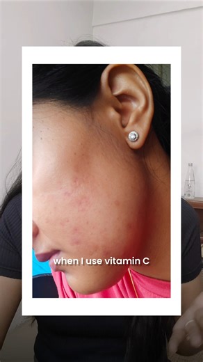 Here is why it is important to use Vit.C which suits your skin! #vit.c #skincare #routine #brighten