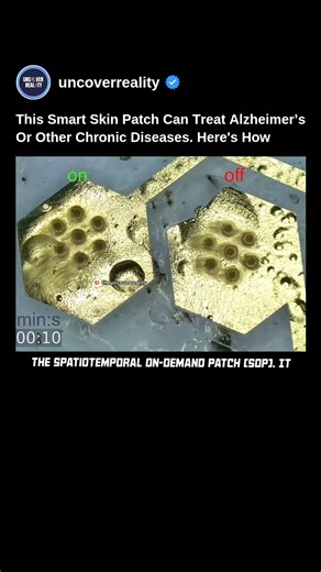 This Smart Skin Patch Can Treat Alzheimer's Or Other Chronic Disease. Here's How #tech #shorts