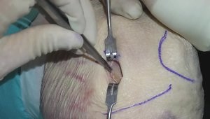 Anteromedial Tenodesis of the Knee
