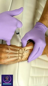 94K views · 340 reactions | Wrist joint injection #medicalanimation | Medical Animation Media | Facebook