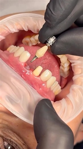 The Smile Finally Looks Complete 😍🦷 | Implant Crown + Front Tooth Crown Transformation