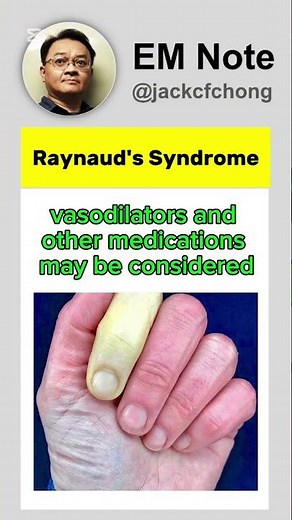Treatment for Raynaud's Syndrome