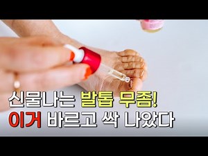 발톱무좀 민간요법 이거 바르면 싹 없어집니다! | 발톱 무좀 약