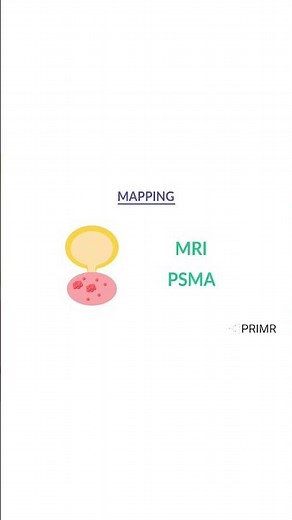 ”I'm a prostate cancer patient—how can electric pulses from IRE improve my cancer treatment?”