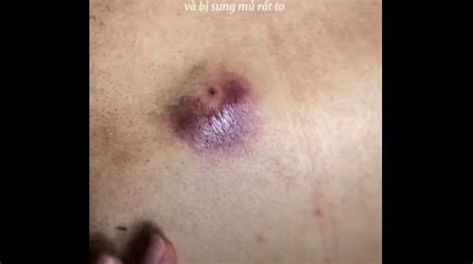 Sebaceous Cyst On Back Explodes