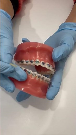 KFO How to wear Class II elastics