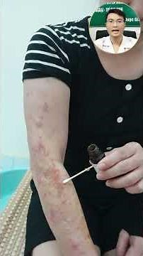 Viêm Da Cơ Địa Hết Thuốc Lại Ngứa, Nổi Mẩn – Tại Sao Vậy?