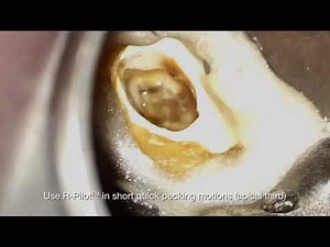 VDW Dental · R-PILOT - Glide path management (clinical video)