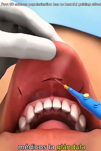 Understanding Thyroidectomy: A 3D Animation Guide