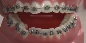 When’s the best time for braces?