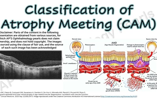 Classification of Atrophy Meeting Reports|Macular Atrophy in AMD - AMD萎缩分型