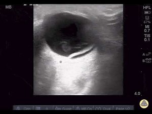 Simultaneous Vitreous & Retinal Detachment