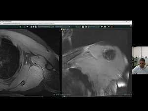 Looking Inside A Pectoralis Major Tear at Atlantic Medical Imaging