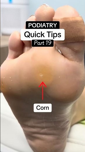 Corn and calluses on the ball of your foot?