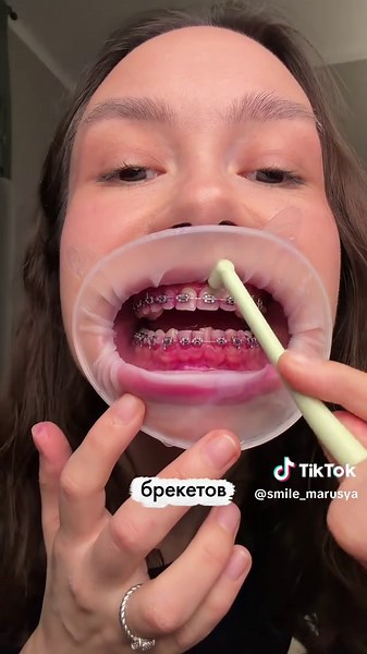 ‏индикатор налета арт. #WW306230 💗 #брекеты РП