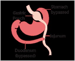 Gastric Bypass Roux-en-Y: A Permanent Solution