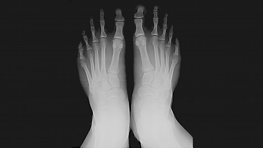 The Era of the Shoe-Fitting Fluoroscope and the Radiation It Caused