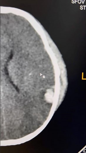 NCCT Head Injury: SDH, SAH & Contusion Explained