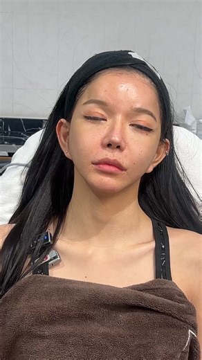 ครึ่งหน้าบุญฟ้า เลิกย้วยแล้ว #รีวิวยกกระชับSLC | SLC Clinic