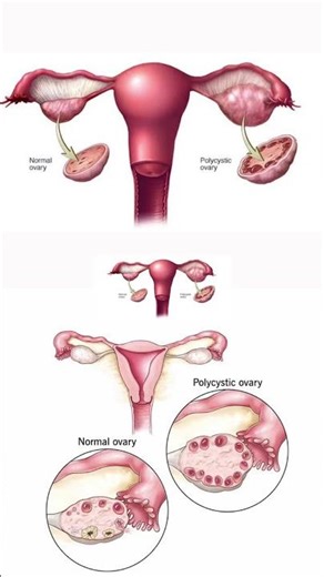 PCOD/ female reproductive health