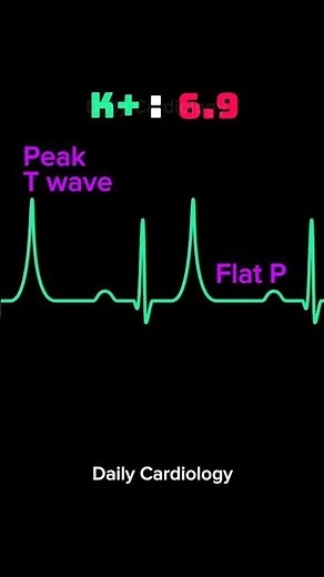 ECG changes in Hyperkalemia #ecg #hyperkalemia #cardiology #medicalemergency
