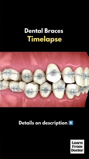 How Dental Braces Move Teeth | 3D Time-Lapse Explanation #DentalBraces #orthodontics