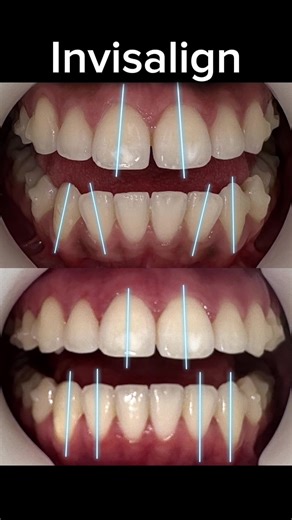 Transform Your Smile with Invisalign Treatment Options