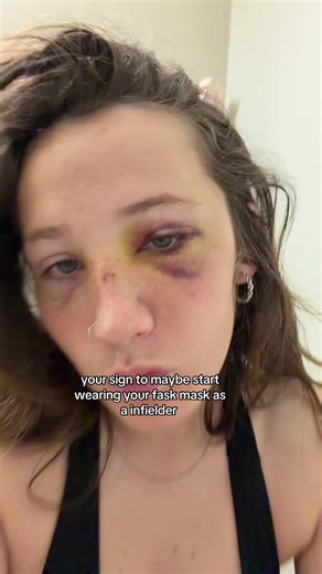 Softball Player Suffers Injuries: Importance of Face Masks