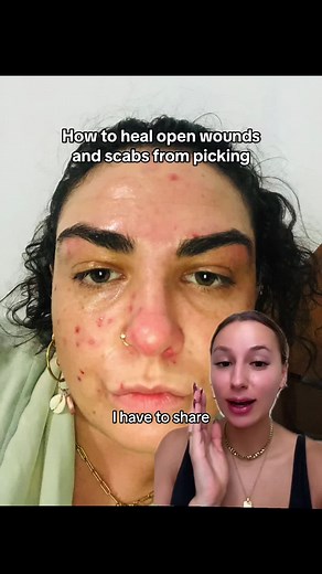 How to Heal Open Wounds and Scabs from Picking