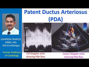 Patent Ductus Arteriosus (PDA)