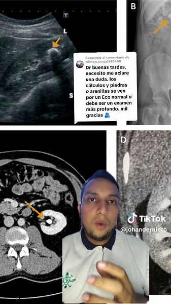 Diagnóstico de Litiasis Renal: Métodos y Síntomas