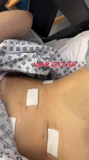 Recovering After Gallbladder Surgery: A Path to Better Health