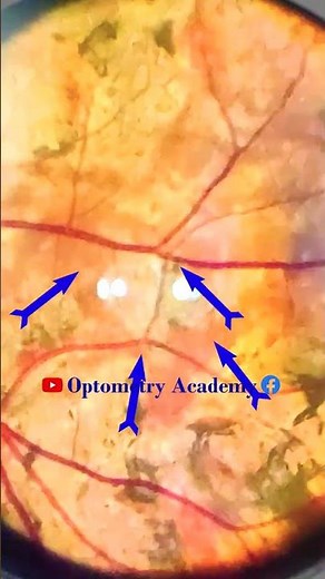 Healed Choroiditis | Serpiginous Choroiditis | Fundus Videography | Fundus | Short Video 320