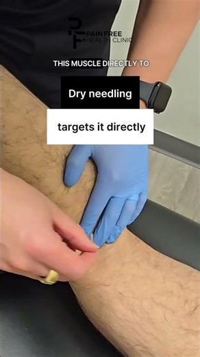 Back of Knee Pain? Fix It by Targeting the Popliteus Muscle (Dry Needling) #KneePainRelief#Popliteus