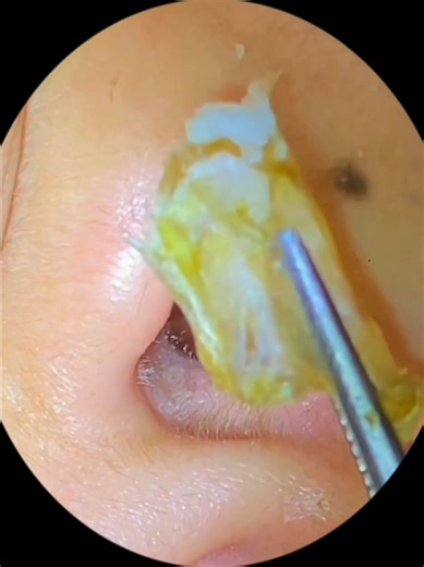 Ear Wax Removal ASMR: Satisfying Cleaning Techniques
