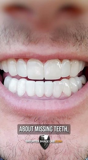 My Veneers from Brighter Image Lab Changed My Life FOREVER!