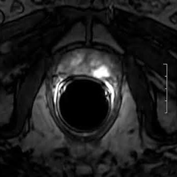 Dynamic MRI acqusition of the prostate gland.