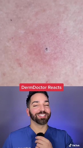 Dermatologist Reacts: Worst Blackhead Removal Tool EVER?