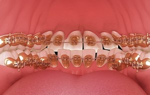 The Ideal Bite | Perfect Teeth Alignment | Orthodontists Associates of WNY