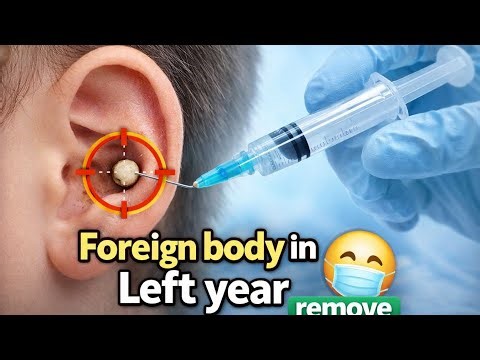 Foreign Body Removal from the Ear | Safe & Smooth Procedure |