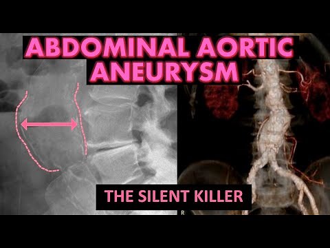 Abdominal Aortic Aneurysm on X-Ray 🚨