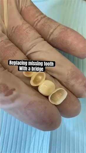 Bridge to replace a missing tooth #dentist