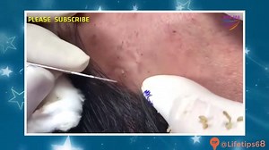 how to removal blackheads & whiteheads on face easy acne treatment videos #05 👉 WATCH OTHER VIDEOS: 1. Worst Case Removal Blackheads On The Face Easy - How To Remove Blackheads Easy 👱$(serial) @ https://fb.com/437944290367265 2. Pus Infection Baby Pimple Beware, these images may shock your sensibilities' @ https://fb.com/715763678844330 3. Infectet Pimple PoP @ https://fb.com/436767680222871 4. Blackheads Removal Spreading Blackheads COMEDONES dilated pore of winer Extraction tough Blackhead @