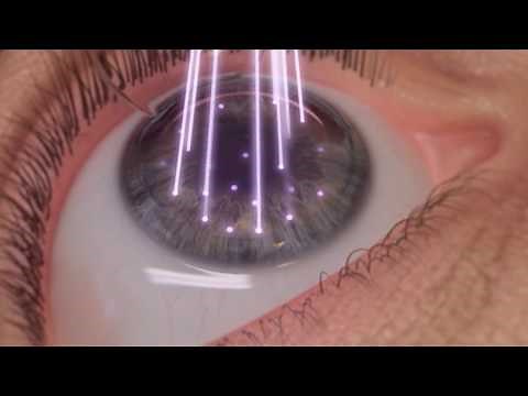 Cirugía refractiva con láser de femtosegundo