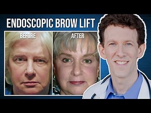Minimal Incision Brow Lift | Cheryl's Testimonial